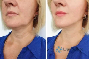 Book your double chin treatment Southend-on-Sea today! We are here to help!