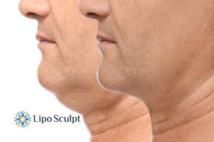 Double chin treatment Southend-on-Sea from Lipo Sculpt - feel more confident today!